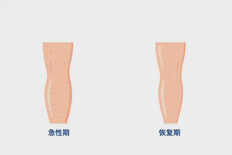 产妇小腿起湿疹康复的全过程