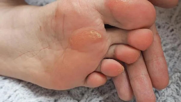 鸡眼动手术多少钱