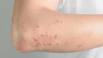 扁平苔藓早期如何检查