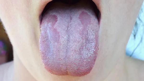 结核病会引起舌苔白吗