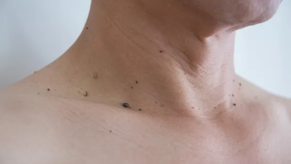色素痣能自愈吗 色素痣常见部位有哪些