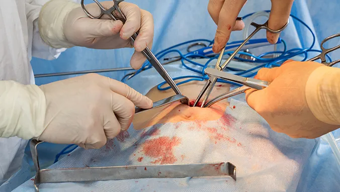 癌性腹水是什么颜色