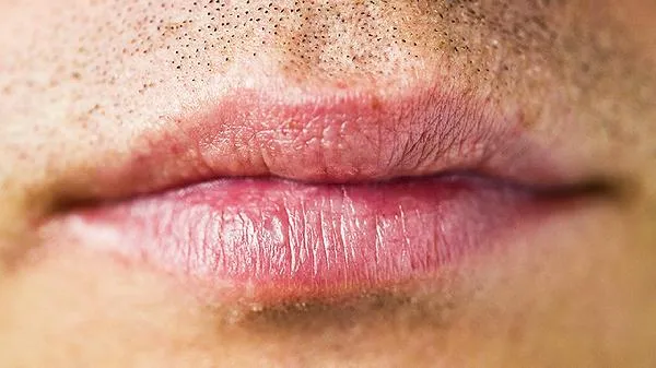 唇部疱疹和唇炎水泡有什么区别