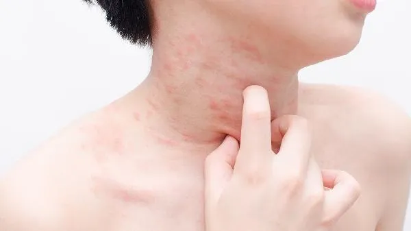 宝宝反复出湿疹是什么原因