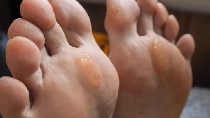 脚长鸡眼怎么治最快