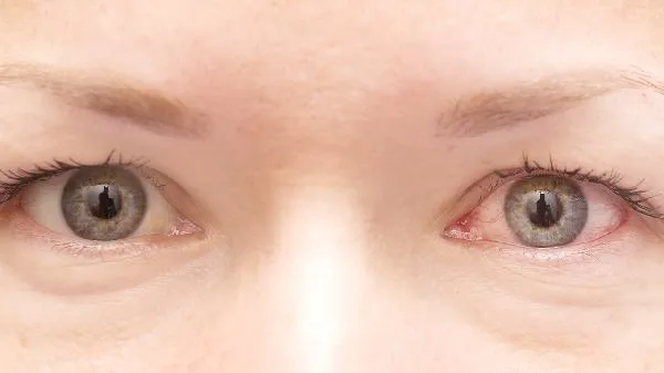 红眼病的传播途径是什么