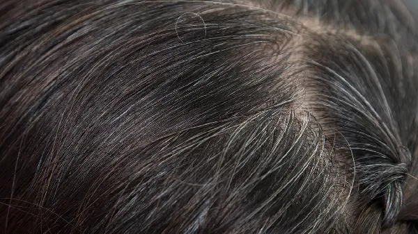 脂溢性脱发检查要抽血吗