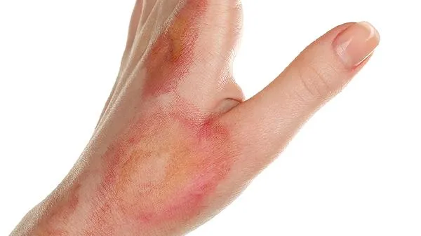 小儿烫伤起泡怎么处理比较好