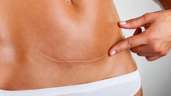 孕妇剖腹产排气最快的方法