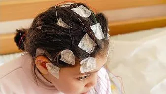 北京有几家治疗癫痫病的医院