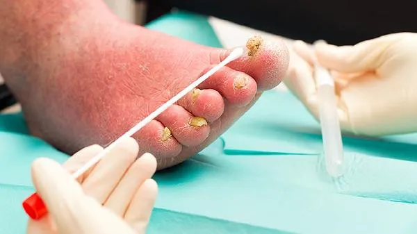 宝宝足底采血阳性危害