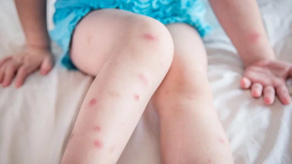 小孩X形腿能自愈吗 儿童X形腿一定要进行矫正吗