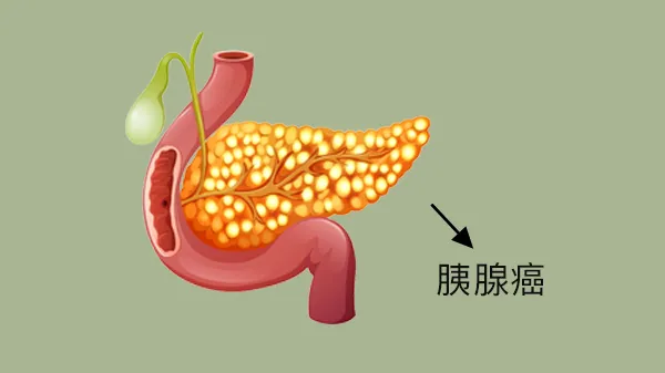 胰腺癌早期什么症状怎样能发现