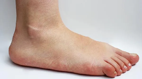 拇外翻对身体有什么影响？