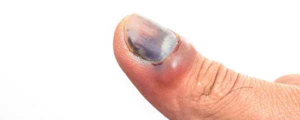 手指甲竖纹黑线是什么 手指甲竖纹黑线是由什么疾病引起的