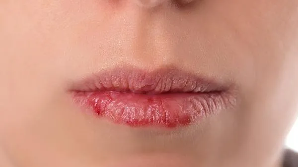口角炎唇炎缺乏是什么引起的