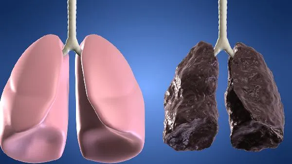 70岁肺癌晚期还有治疗意义吗