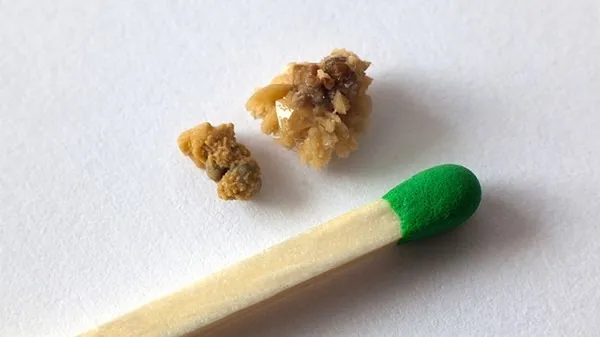 肾结石不痛需要治疗吗？及时治疗