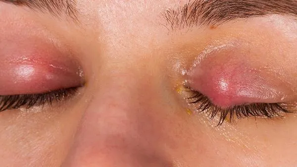 霰粒肿不用管它行不行