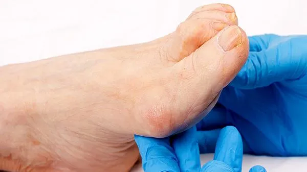 嘴巴感染脚气有什么症状