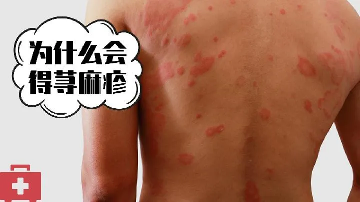 慢性盘状红斑狼疮用药