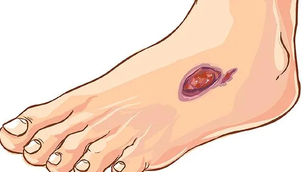 肺脓肿用哪种抗生素治疗好