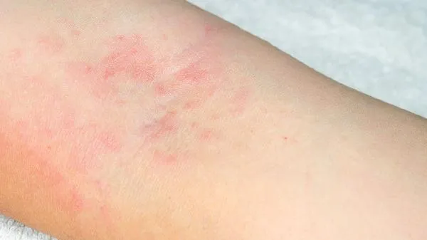 不痒的体癣是什么癣