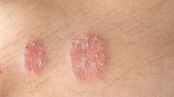 中医怎么治疗银屑病