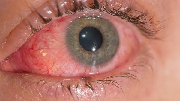 泪囊炎的诱发因素有哪些 若是出现这4点一定要注意了