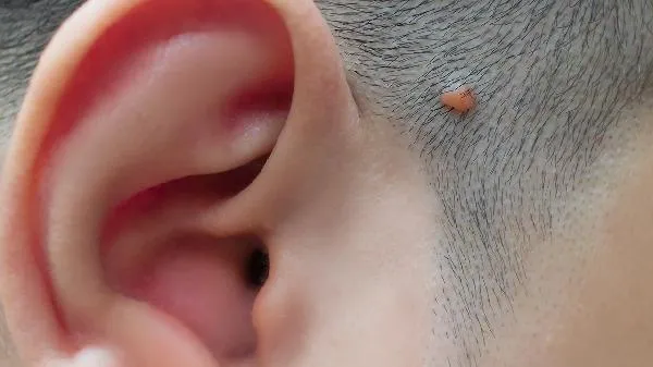 皮肤纤维瘤需要治疗吗多少钱一个疗程呢