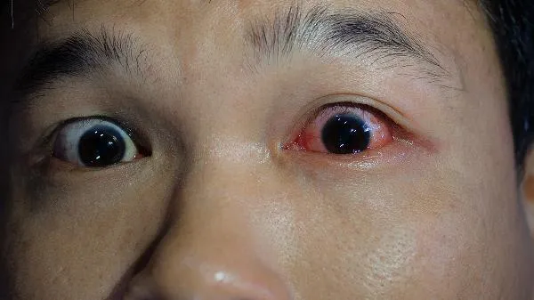 红眼病是怎么样的