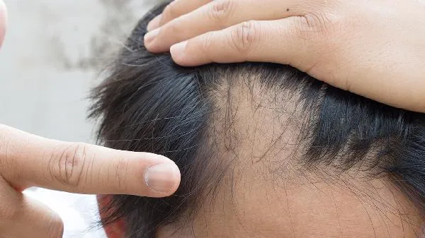 脂溢性脱发要做什么检查