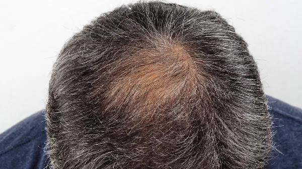 男性脱发怎么治疗效果好