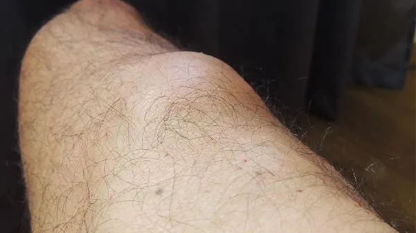 皮肤纤维瘤需要治疗吗多少钱一个疗程呢
