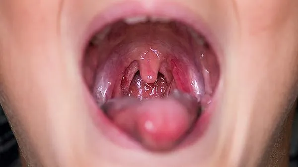 小孩急性喉炎怎么办