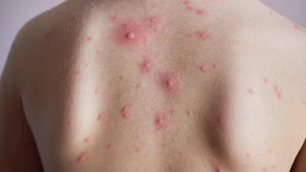 新生儿脸上长痱子了怎么办