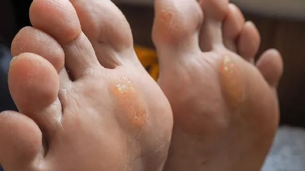 12岁孩子脚臭的厉害怎么办
