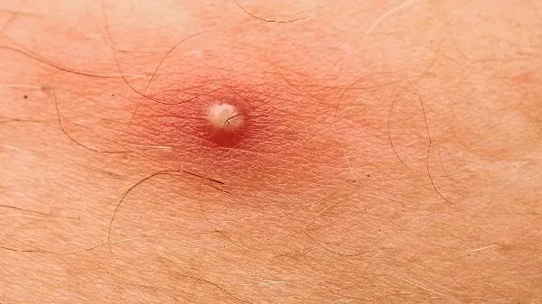 皮肤为什么那么黄