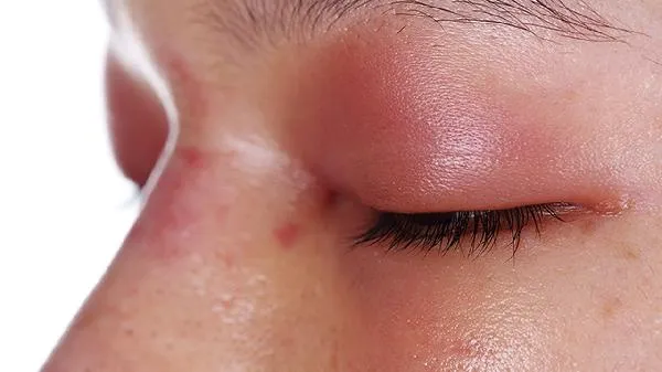 婴儿咖啡斑自己就退了