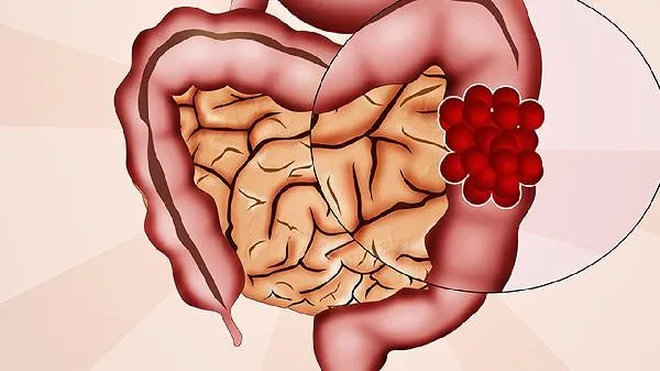 新生儿肠粘连有危险吗