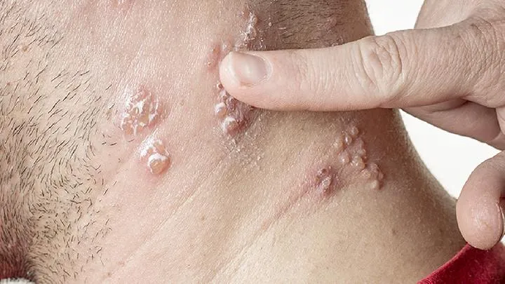 宫颈hpv阳性是什么意思