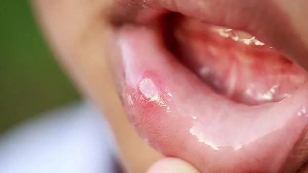 十二指肠球部溃疡糜烂严重吗