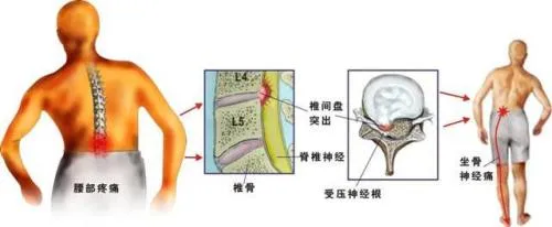 腰椎间盘突出怎么治疗？少不了它！坐骨神经痛的治疗方法也是如此吗？