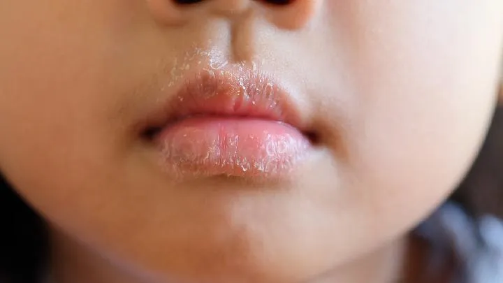 婴幼儿常见的8种疾病