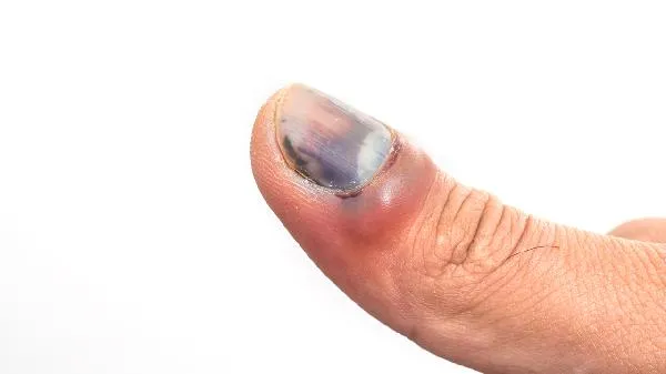 孩子爱啃指甲是什么原因