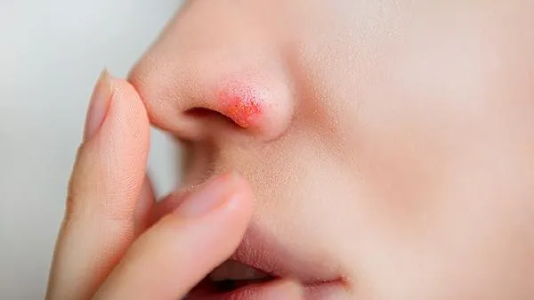 宝宝鼻外伤引起出血怎么办