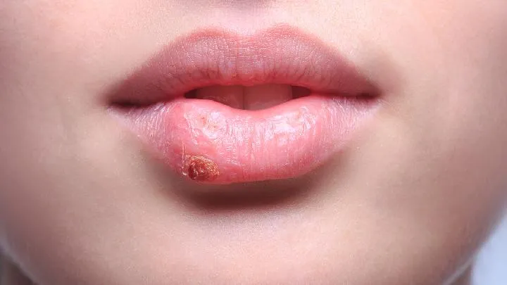小儿疱疹性口腔炎