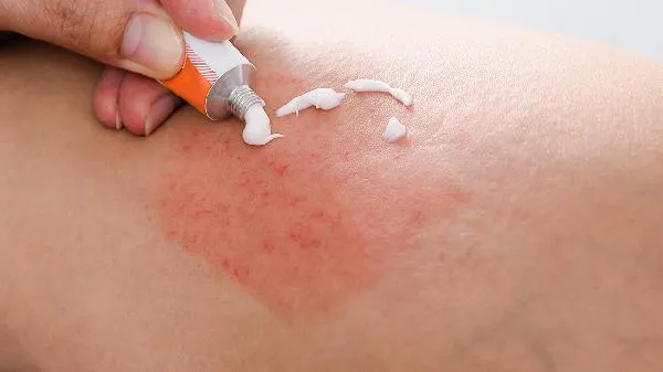 婴幼儿病毒性疱疹咽炎