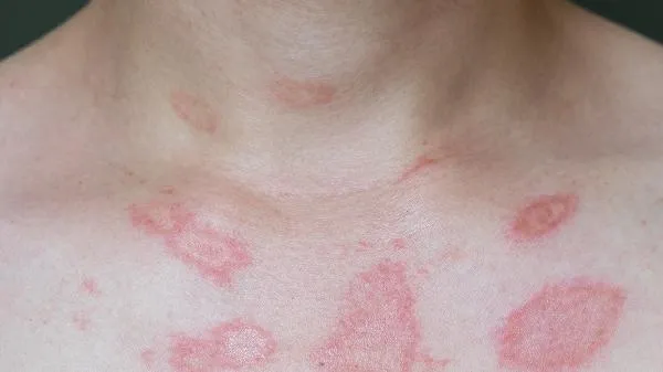 牛痘能治疗天花吗