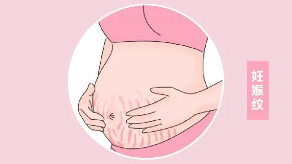 孕期妊娠纹以后会消失吗